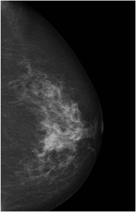 dense breast houston