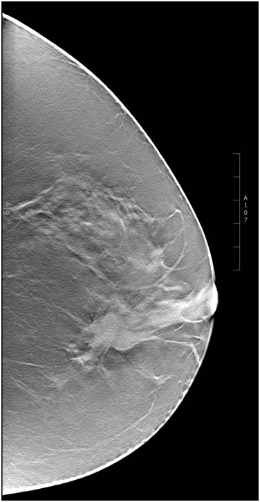 dense breast exam