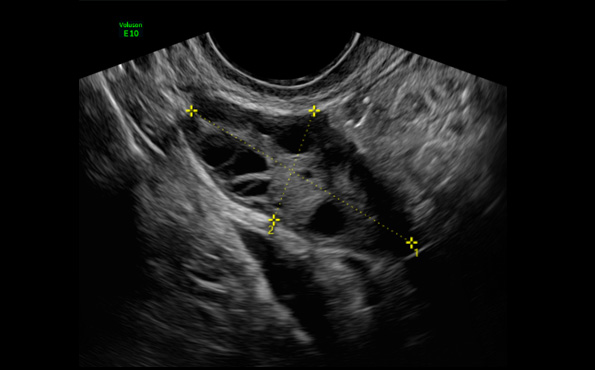 Pelvic Ultrasoung Gynecological Imaging