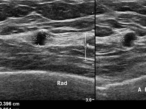 Breast diseases