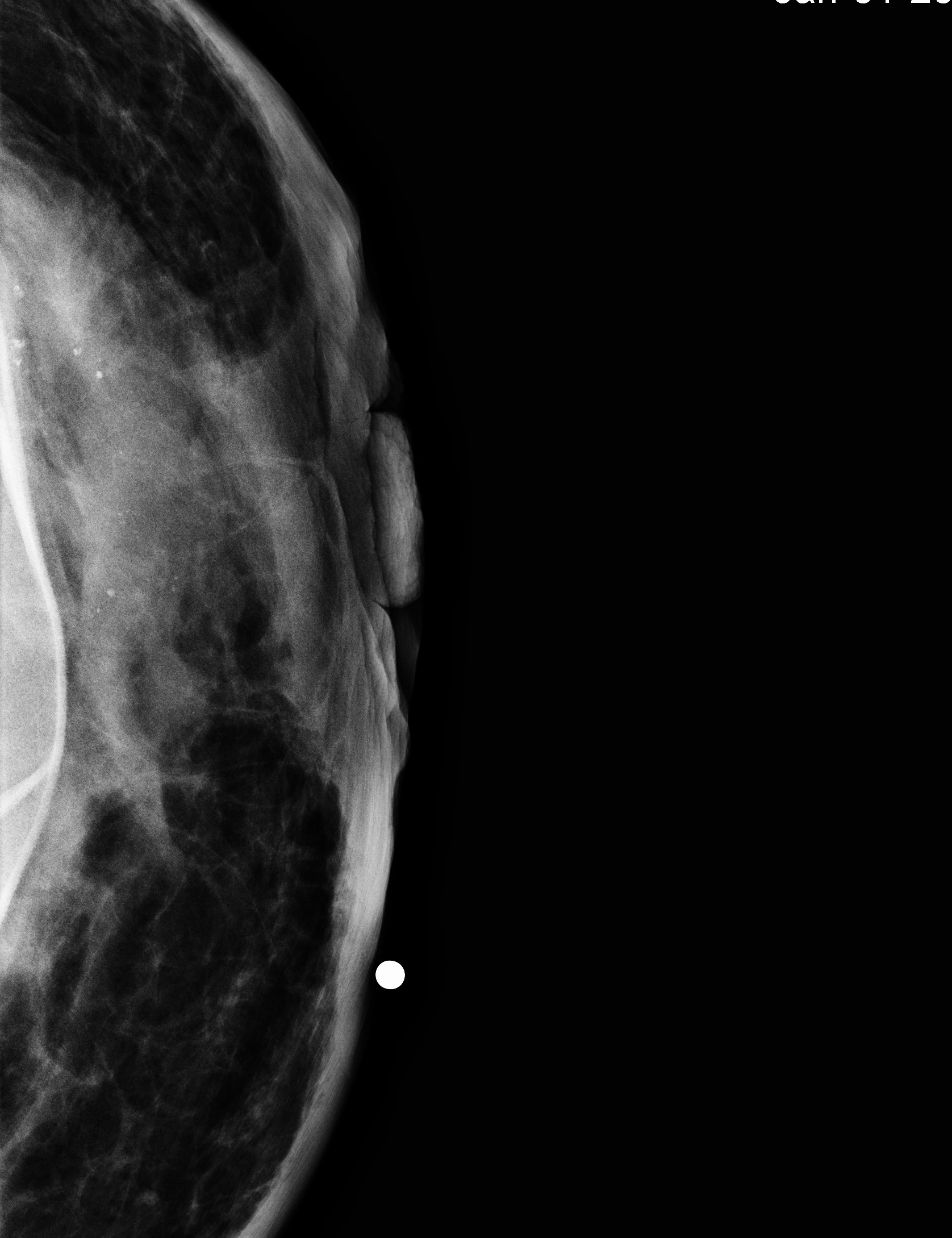 Figure 1 Mammogram