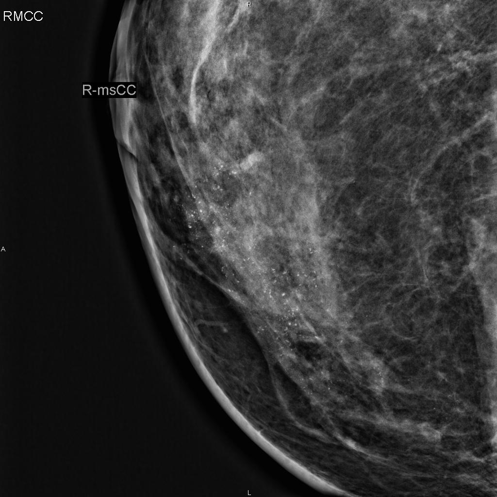 Figure 4 Paget disease of the nipple