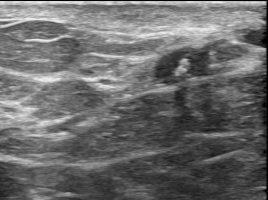 nipple discharge ultrasound