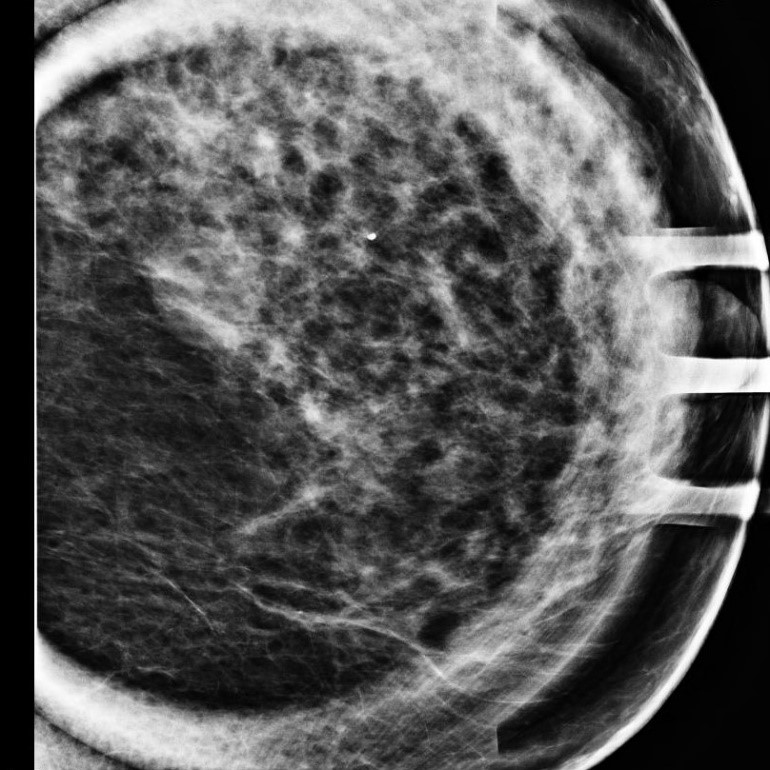 breast pain & fibrocystic change Houston