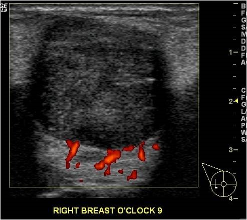 breast cancer radial