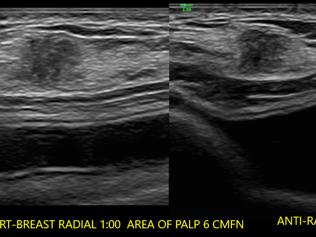 breast ultrasound radial