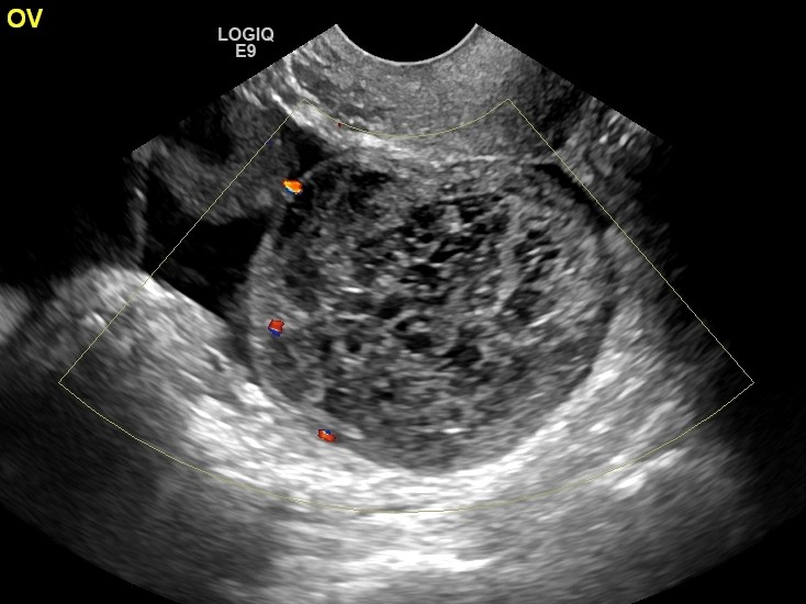 pelvic ultrasound houston