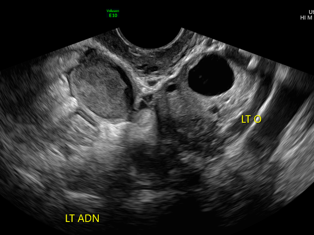 pelvic pain ultrasound