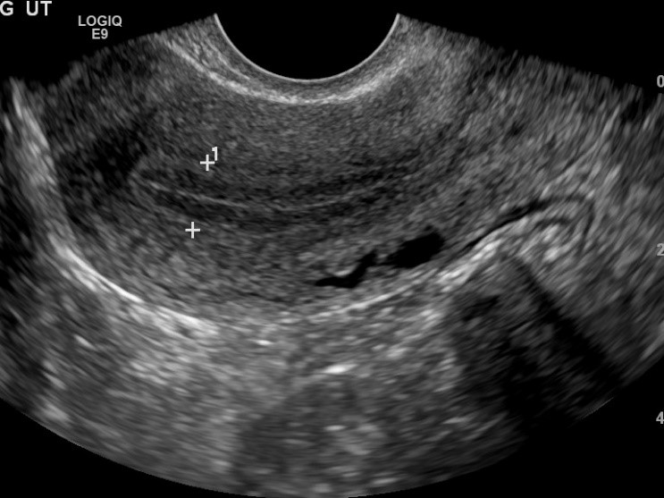 pelvic ultrasound for vaginal bleeding
