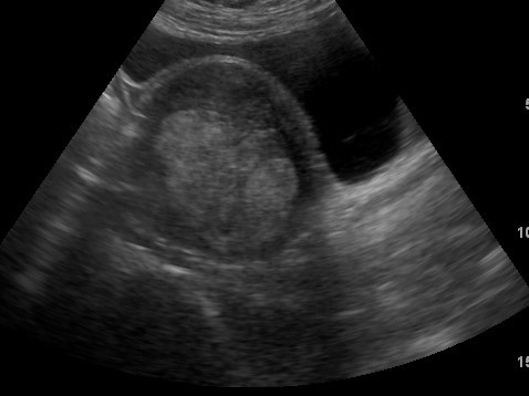 abnormal transvaginal ultrasound