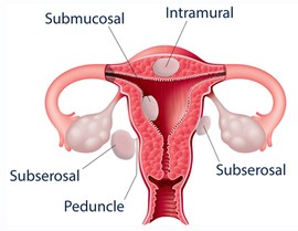 abnormal vaginal bleeding houston