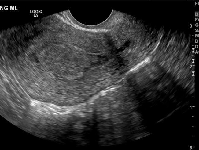 abnormal transvaginal ultrasound