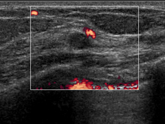 breast cancer detection with ultrasound