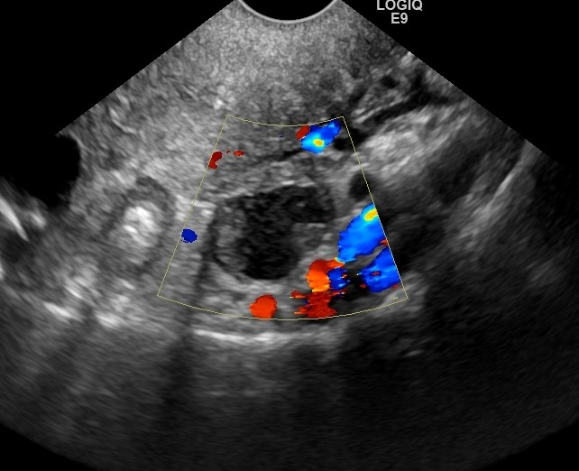 Ovarian Cancer Tumor Ultrasound