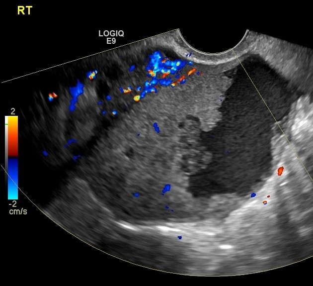 Ovarian Cancer Tumor Ultrasound 