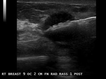 Ultrasound guided core needle biopsy of a solid tumor in the breast