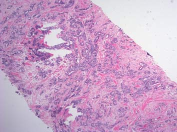 Histological sample shows cancer cells