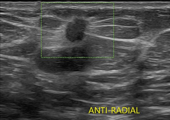Breast Ultrasound sonogram picture