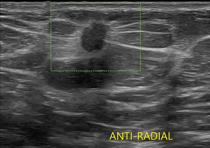 invasive ductal carcinoma ultrasound